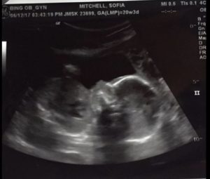 pregnancy 5 month ultrasound