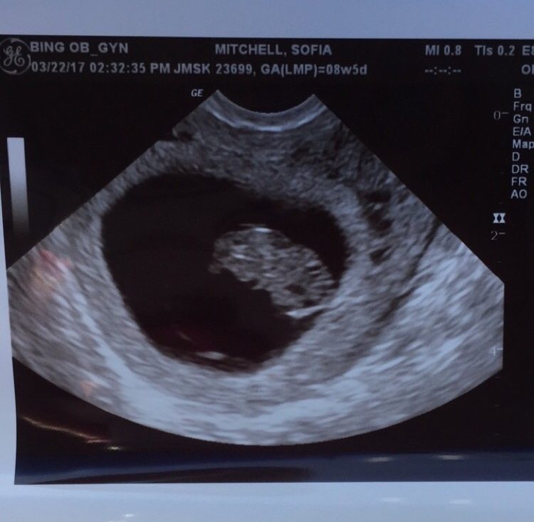 my first time being pregnant, pregnancy ultrasound scan